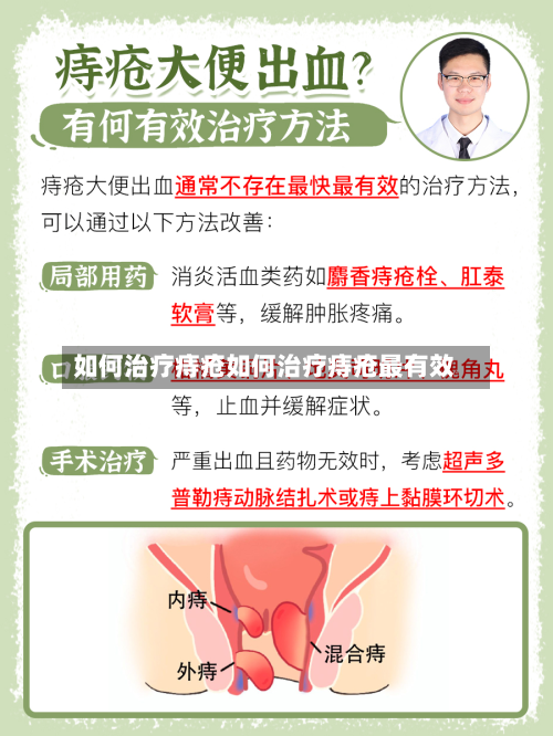 如何治疗痔疮如何治疗痔疮最有效
